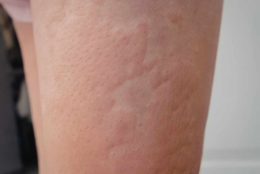 Skin Rashes & Aircon: Does Air Conditioning Help Or Hurt? - DEEPCHILL