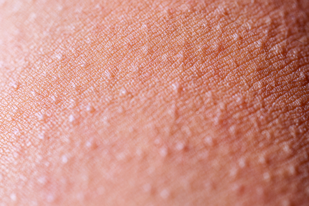 Close-up of bumpy skin rashes, which may leave people wondering: can air conditioning cause a rash by stripping the skin of its natural moisture?