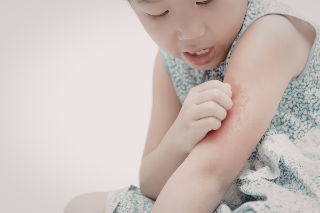 A young girl scratching itchy, red skin rashes on her arm. Regular cleaning of your residential air conditioning Gold Coast unit helps prevent the circulation of dust and allergens that can trigger skin irritation in children.