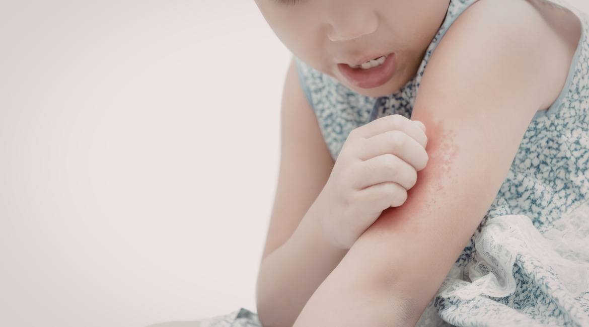 A young girl scratching itchy, red skin rashes on her arm. Regular cleaning of your residential air conditioning Gold Coast unit helps prevent the circulation of dust and allergens that can trigger skin irritation in children.