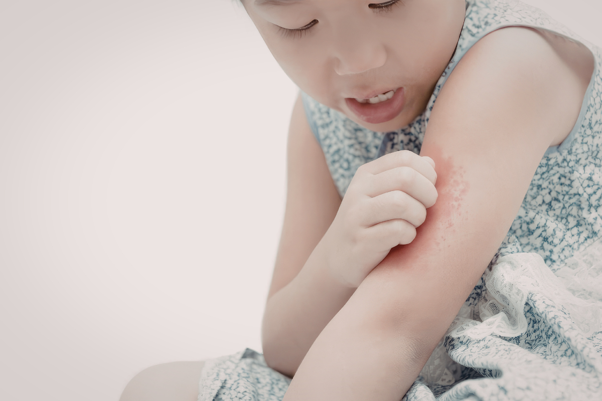 A young girl scratching itchy, red skin rashes on her arm. Regular cleaning of your residential air conditioning Gold Coast unit helps prevent the circulation of dust and allergens that can trigger skin irritation in children.